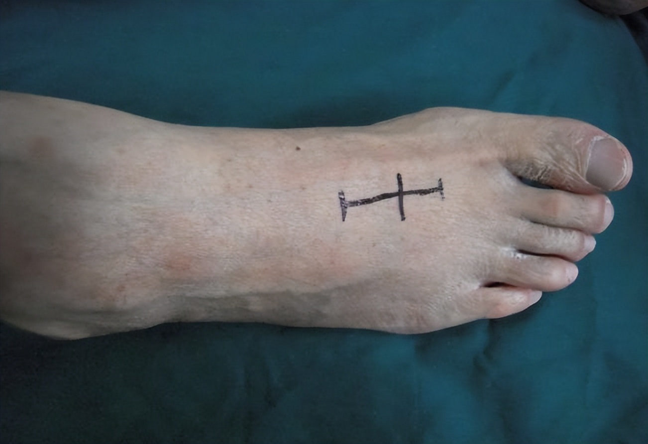 下肢寒凉麻木,糖尿病引起的下肢麻木如何治疗