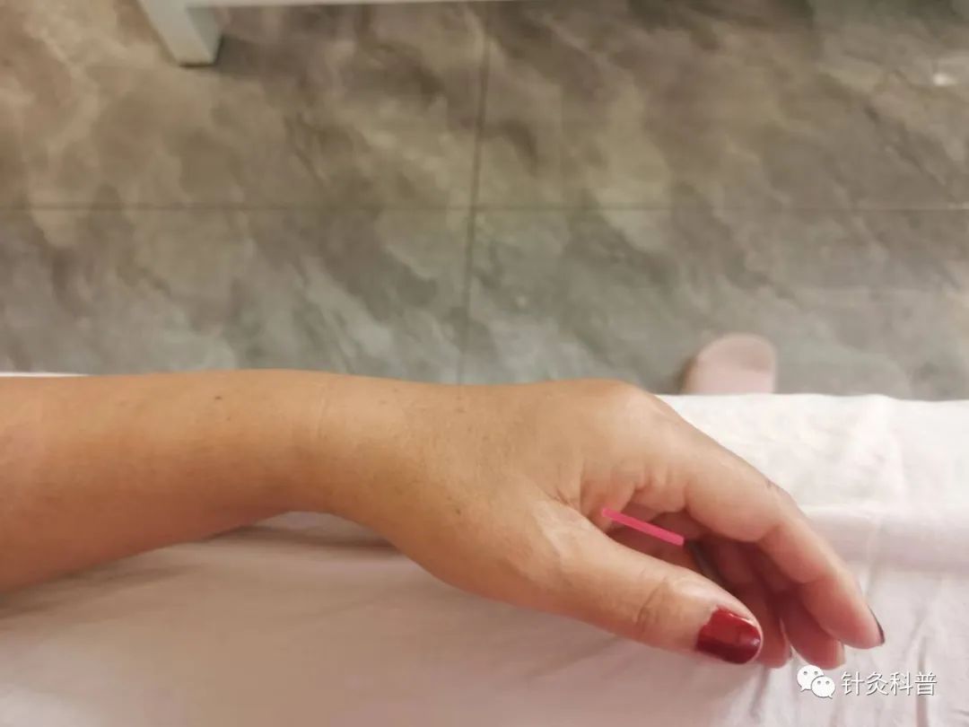 喉咙热有烧灼感针灸,舌头有烧灼感针灸方法