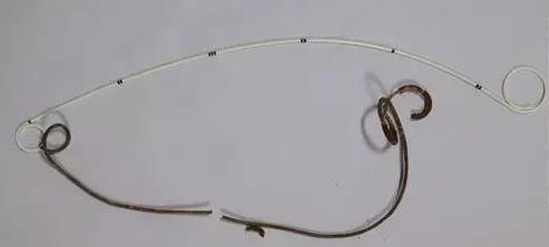 泌尿系结石术后护理查房,门诊输尿管结石微创术后注意事项