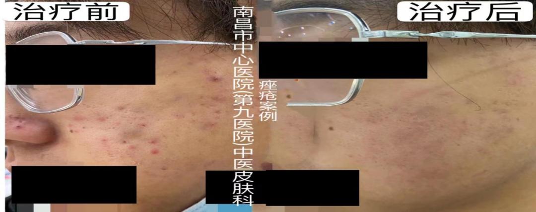 想拥有光滑无痘的脸，别再做这个动作了