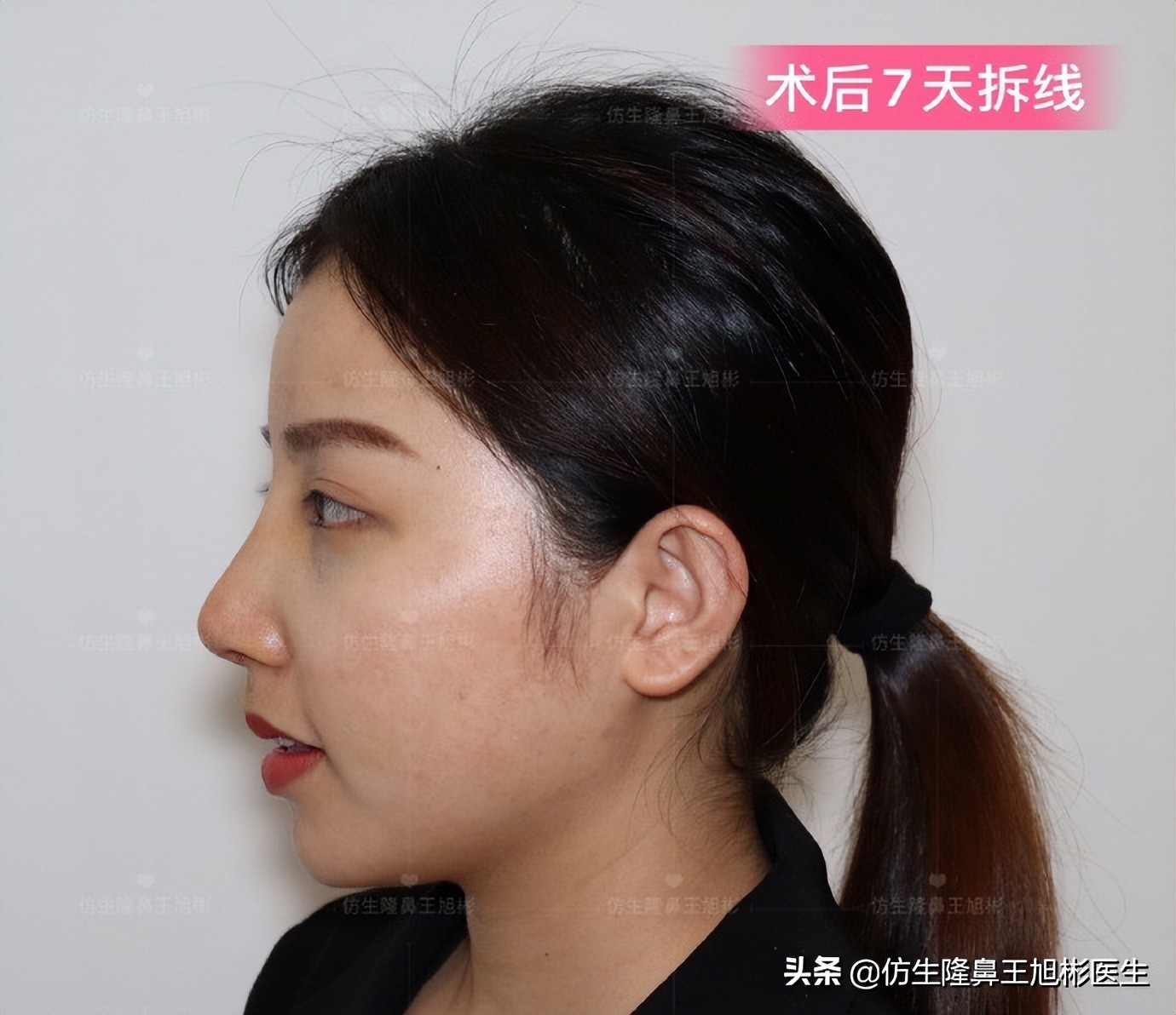 手术鼻头增厚能用什么方法弄,大鼻头高鼻梁缩小手术案例