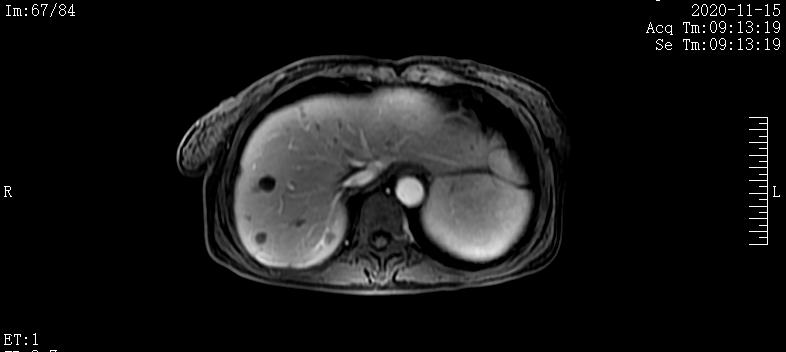 病例实录|免疫联合方案治疗胰腺癌多发转移的病例分享