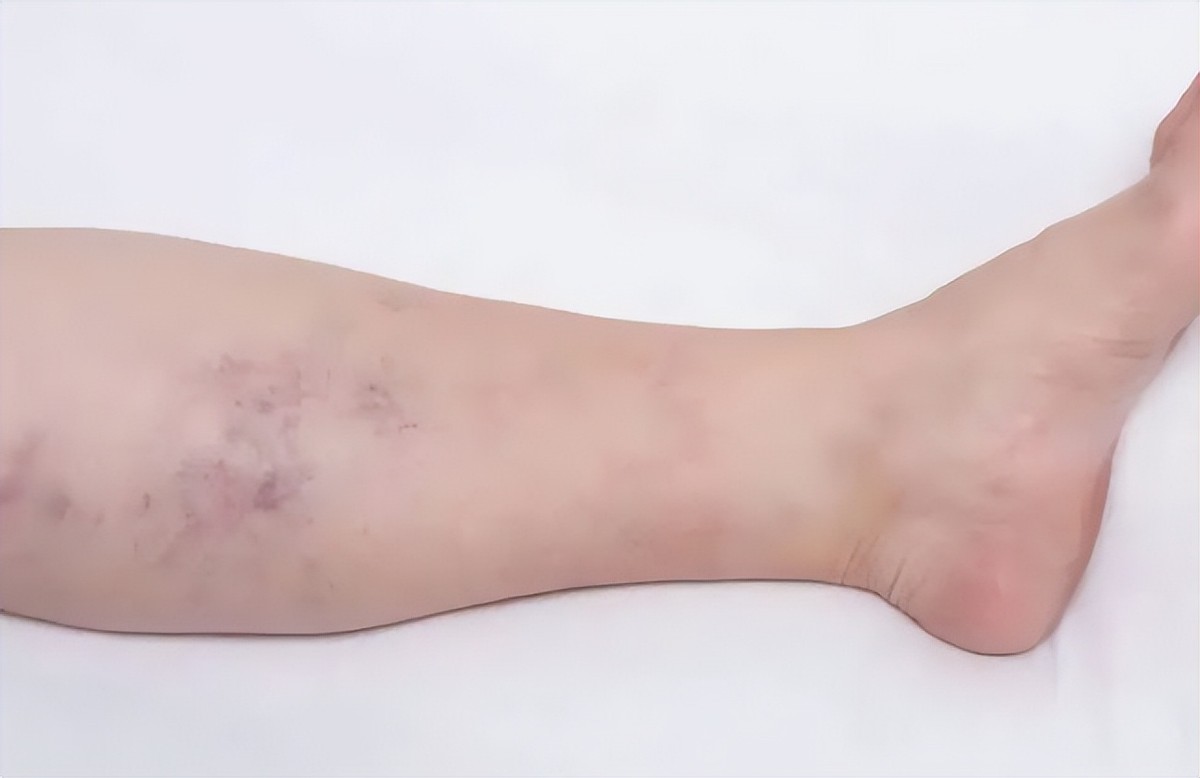 河北19岁女孩抗癌,清华女学霸患癌之后积极抗癌