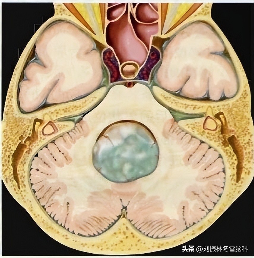 头痛恶心呕吐后缓解,小儿头痛呕吐是怎么回事