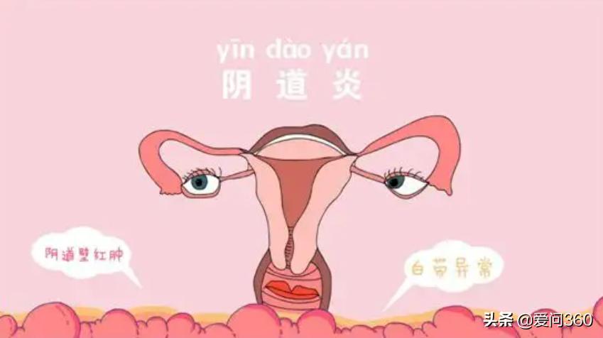 阴道炎刚开始会有什么症状,阴道炎来前症状