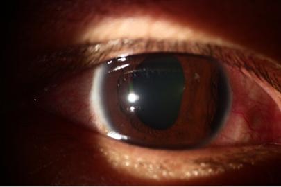 重现光明换眼手术,眼科医生帮助患者恢复光明