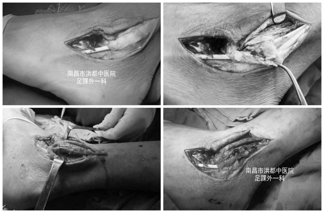 脚踝扭伤腓骨肌腱脱位的症状,踝关节外侧韧带损伤发病原因