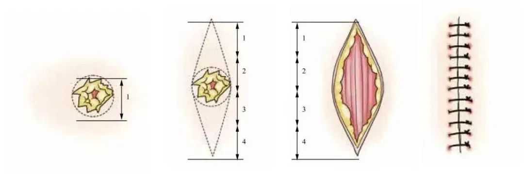 外科顶级缝针技术,外科缝合的操作细节你掌握多少