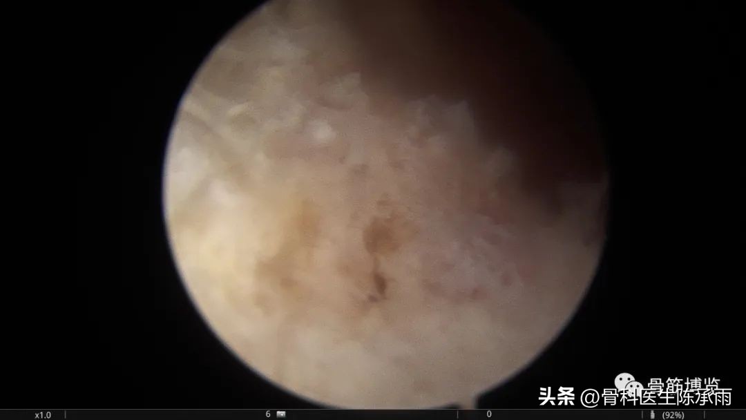 化脓性关节炎的穿刺引流治疗,关节炎镜下治疗