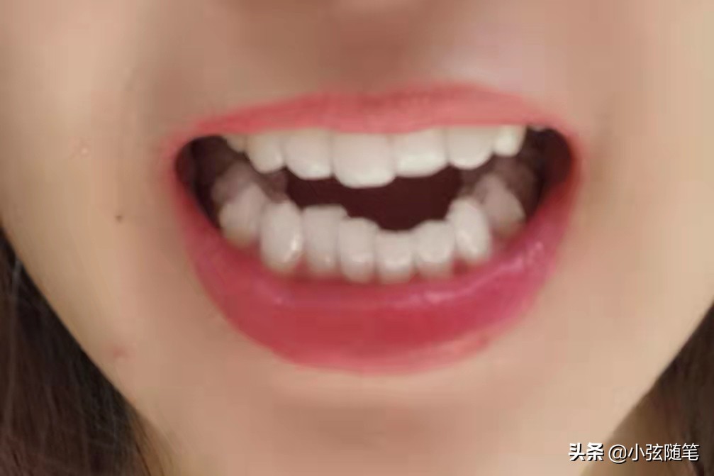 做隐形牙齿矫正真实全过程,成年人隐形牙齿矫正