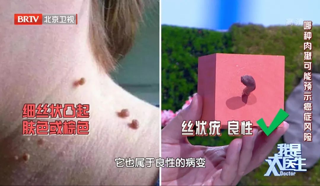 皮肤出现小疙瘩一抠一个小洞,身上出现这些小疙瘩请注意了