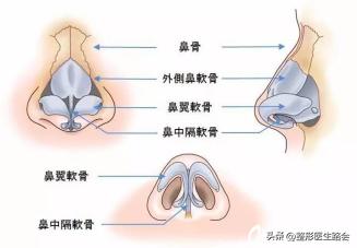 隆鼻后为什么没用夹板,隆鼻后鼻头感觉有点歪怎么办