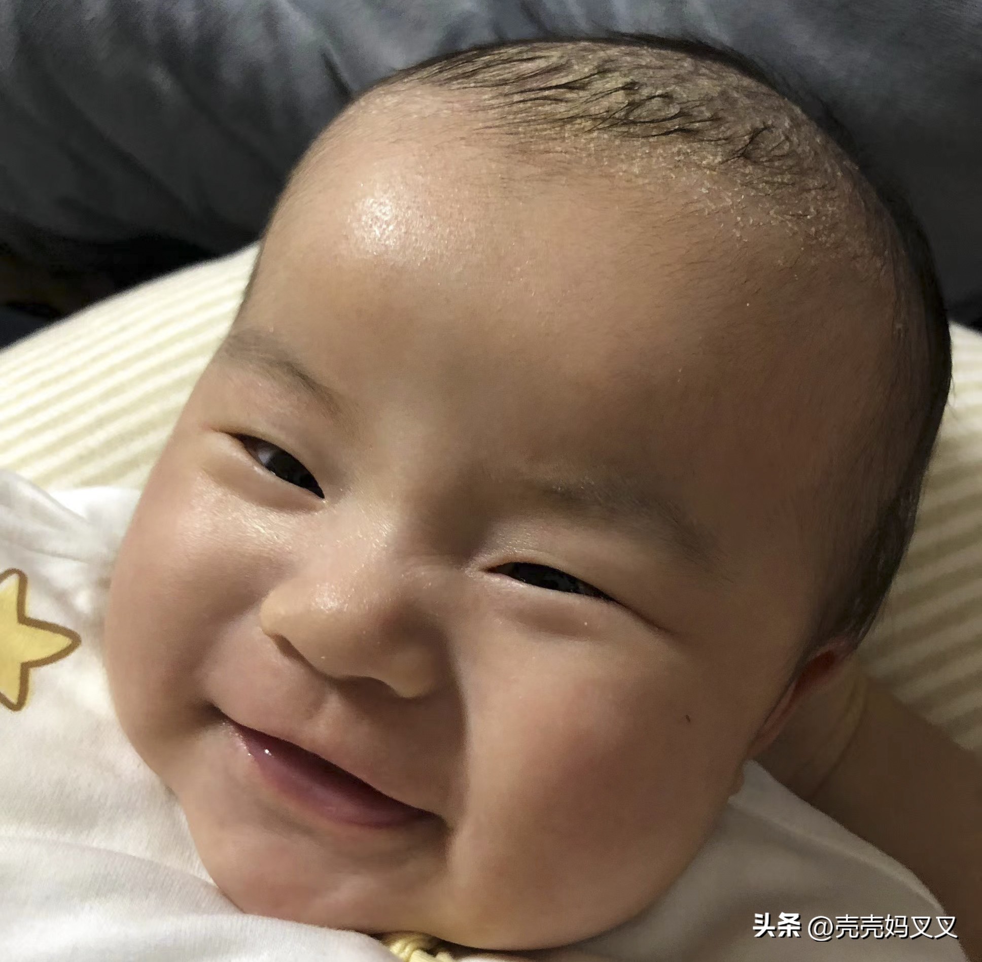 宝宝头皮奶痂用手抠了没事吧,千万不要用你的手去抠宝宝头垢