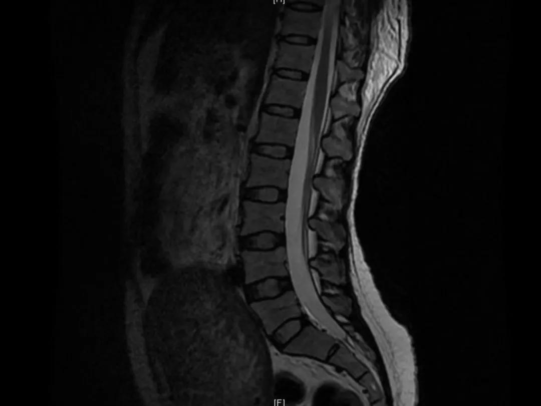 课件分享丨腰硬联合麻醉后，患者脑脊液持续漏出，怎么办？