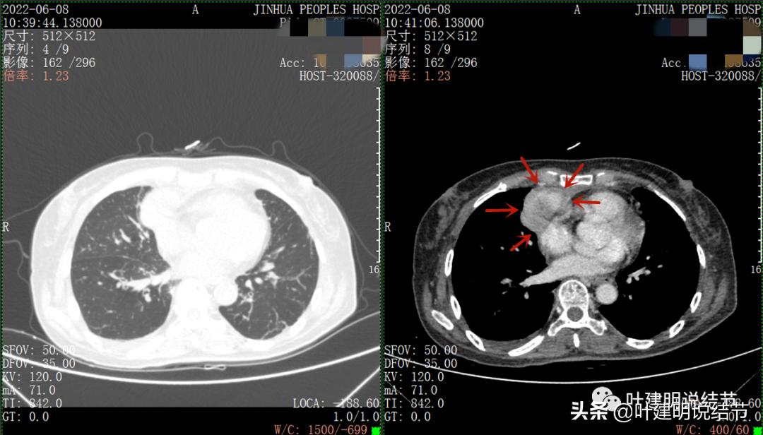 这位老乡，乏力来查，查出这么大个的纵隔肿瘤！会是什么呢？