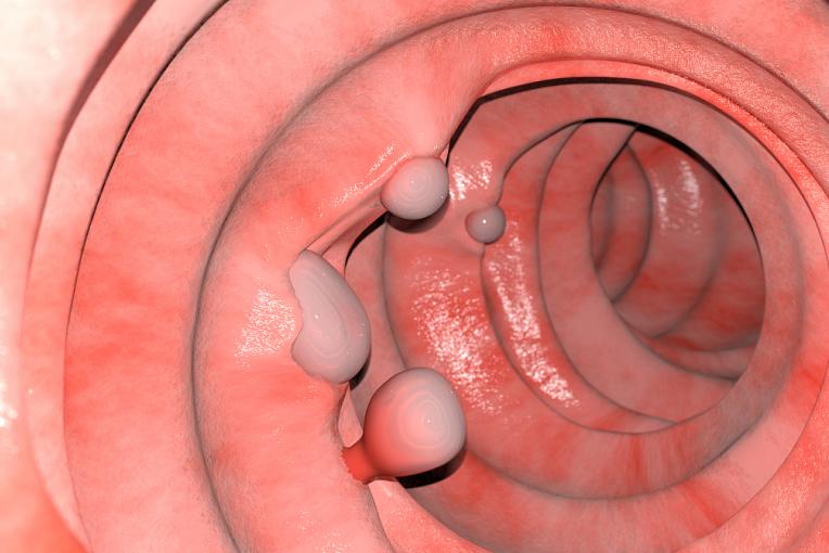 为什么会肠道长息肉,肠道容易长息肉是什么原因