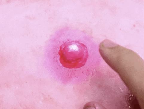 脸上到处是痘痘痘印痘坑怎么办,痘痘破了怎么处理不会留痘印痘坑