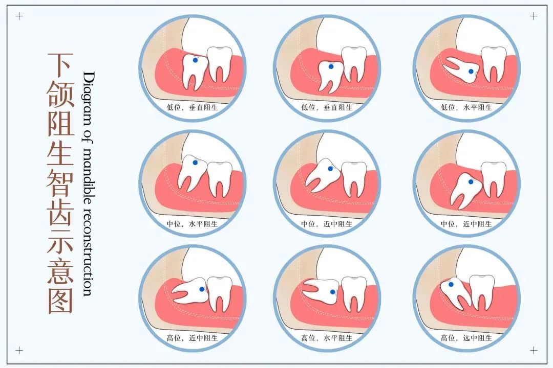 智齿不痛但是不舒服,智齿到底要不要拔医生告诉你答案
