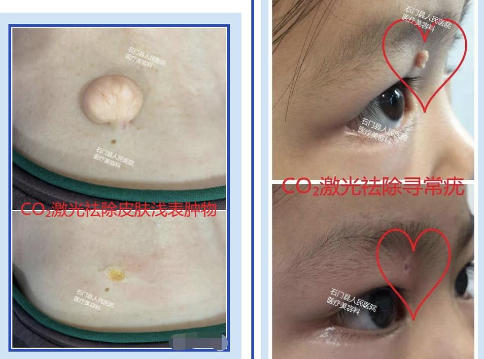 哪些痣应该点哪些痣不应该点,痣多适合什么点痣方法