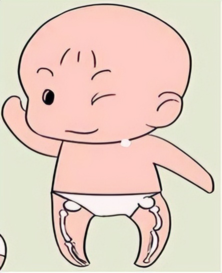 小腿变弯曲是缺钙了吗,小腿变弯处理方法