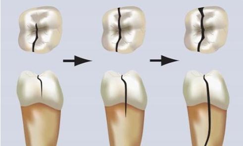 牙齿有裂纹是什么原因怎么办,牙齿有裂纹需要注意什么