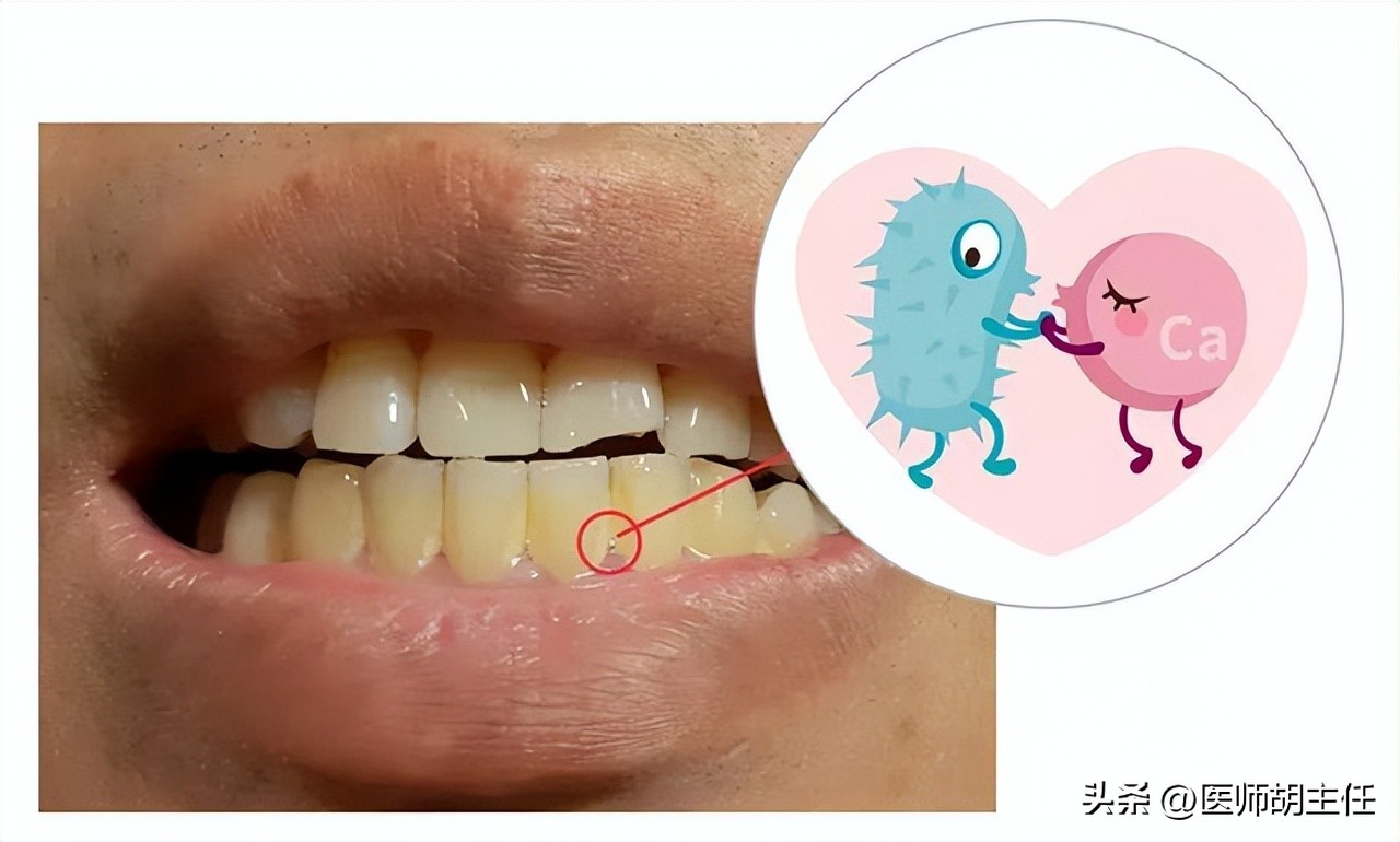 清理牙缝牙结石最有效方法,如何清除牙缝里的牙结石