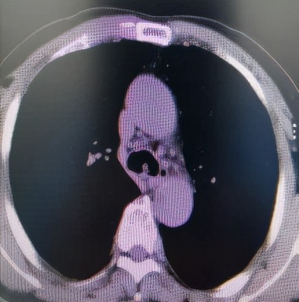 哈医大一院气管镜,哈医大群力呼吸内科