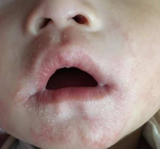 哪些激素面霜不能给宝宝用,怎么辨别小孩的面霜含不含激素