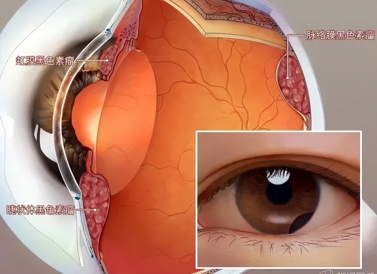 痣提前弄掉会导致黑色素瘤吗,痣和黑色素瘤哪个可以抠掉