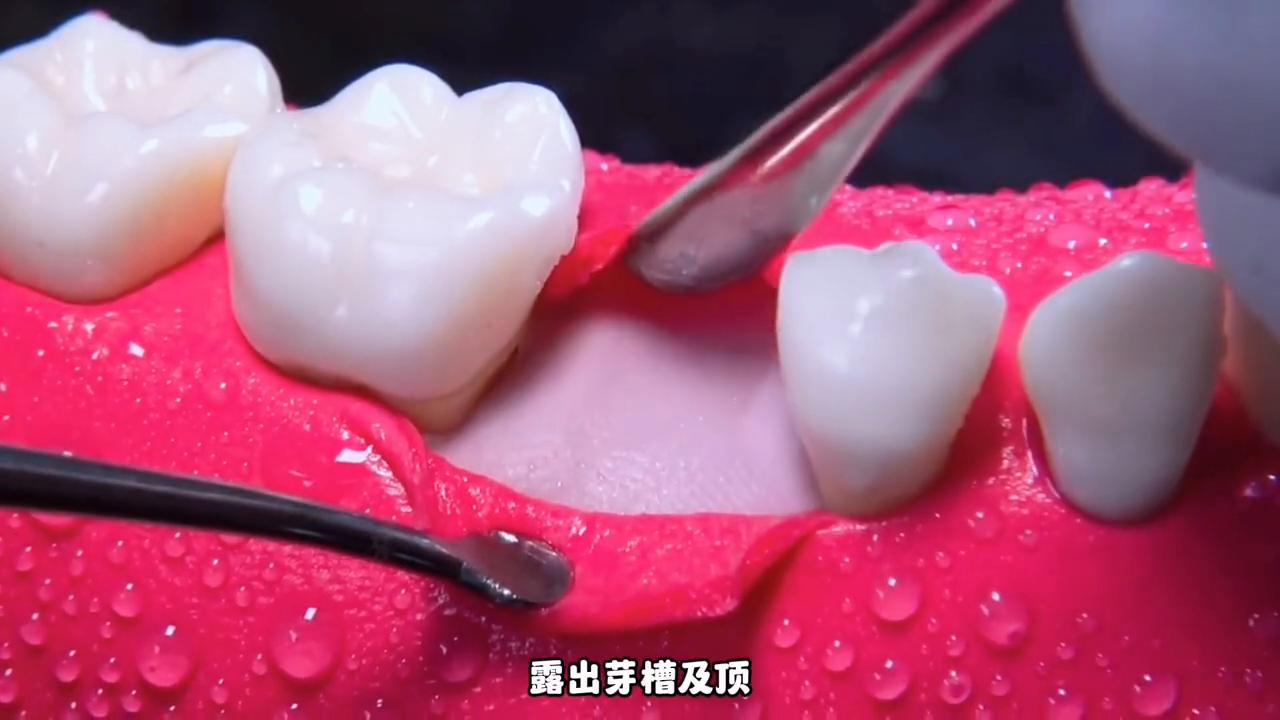 大牙劈裂到种植牙全过程,沉浸式牙齿根管治疗