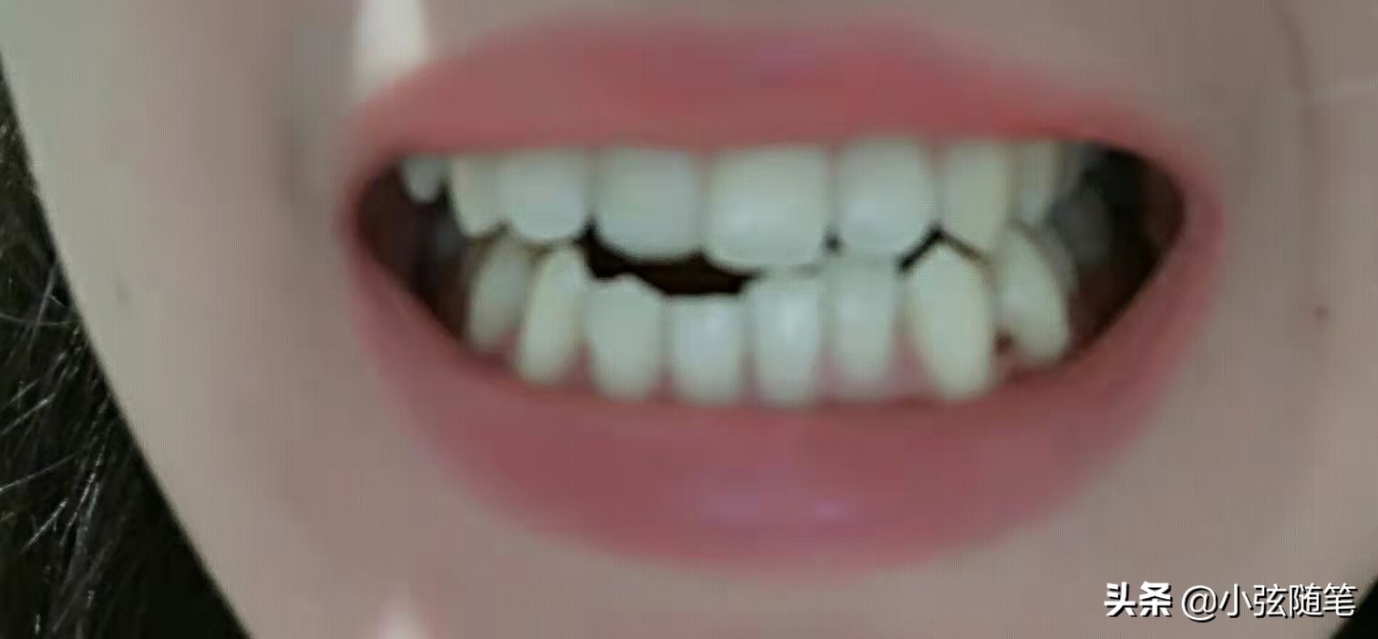做隐形牙齿矫正真实全过程,成年人隐形牙齿矫正
