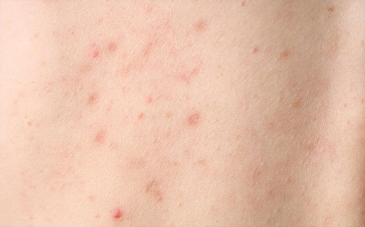 外阴癌前病变患者注意事项,得了早期外阴癌怎么办