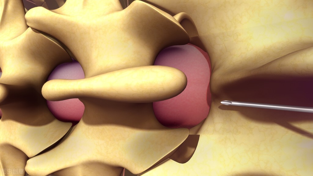 腰部麻醉导致的腰疼能自愈吗,从腰打麻醉有哪些后遗症