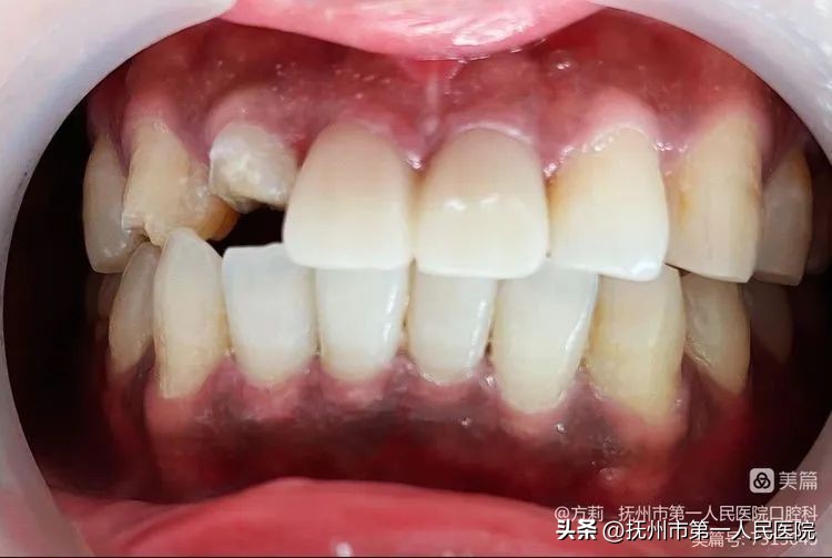 种植牙可修复多种牙齿缺失类型,学科建设口腔科