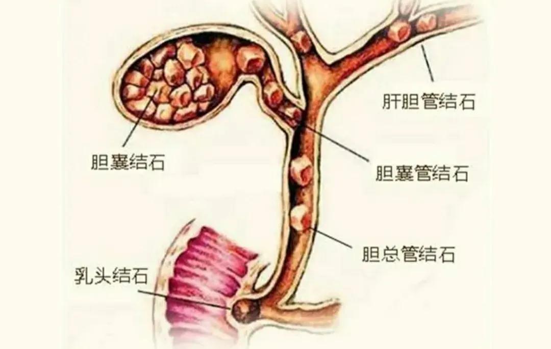 上热下寒乌梅丸加牡蛎,乌梅丸治疗胆道蛔虫症