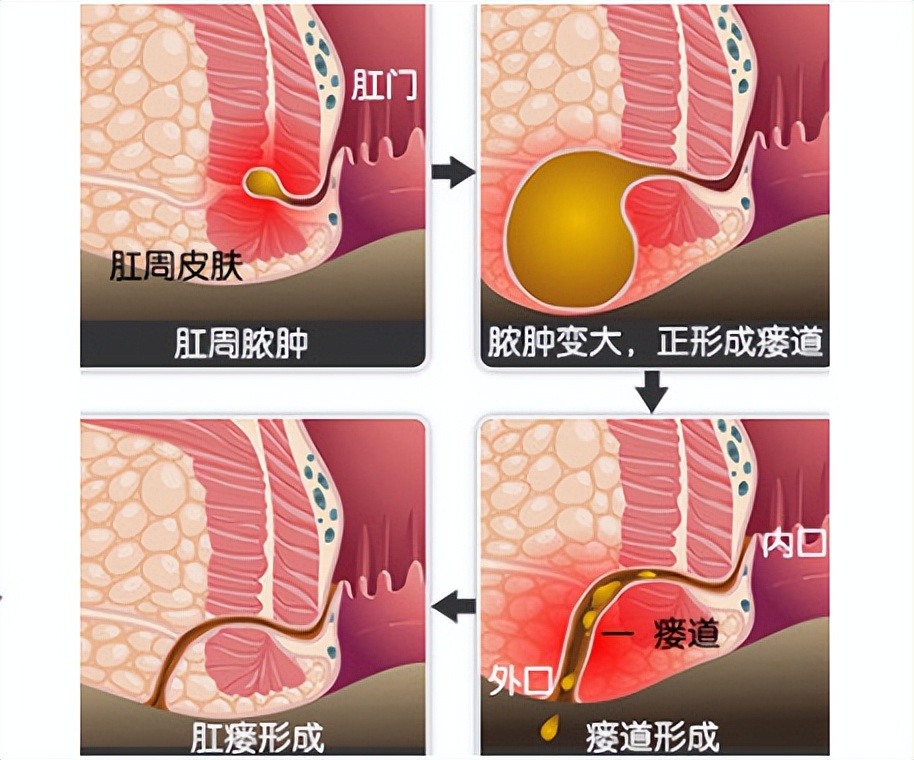 中医肛瘘的辨证论治,肛瘘中医和西医哪个好