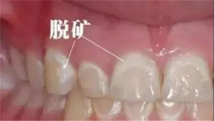 牙齿龋坏有什么严重后果吗,牙齿坏的危害