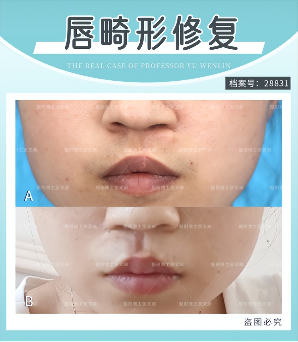 唇裂伴牙槽裂修复效果,唇裂二次修复手术费用