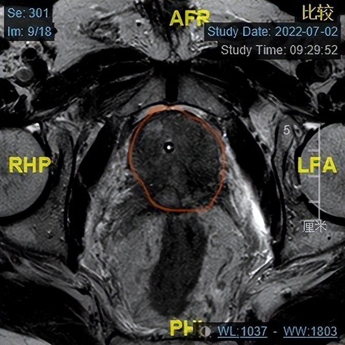 哈医大一院泌尿外科“新辅助”神奇疗法可缩小前列腺肿瘤为晚期前列腺癌治疗带来新方案