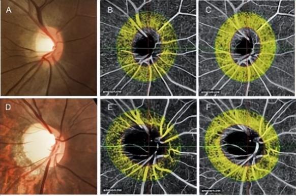 青光眼与近视的关系,孙兴怀教授视频第一集