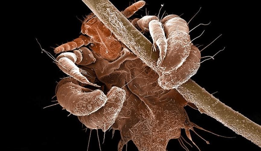 女子腹部痒，医生用镊子夹出16只阴虱！原来阴虱有4个传播途径