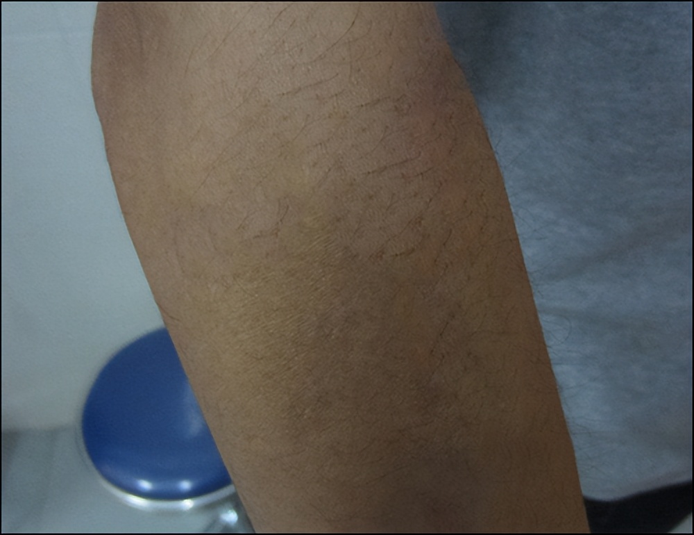 郑州市第一人民医院祛疤,郑州第二中医院治疤痕多少钱