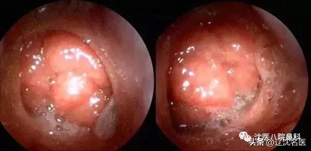 做完扁桃体手术孩子打鼾更厉害了,儿童打鼾危害大