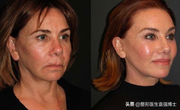 肚皮松弛拉皮手术有副作用吗,脸上做拉皮手术有无副作用