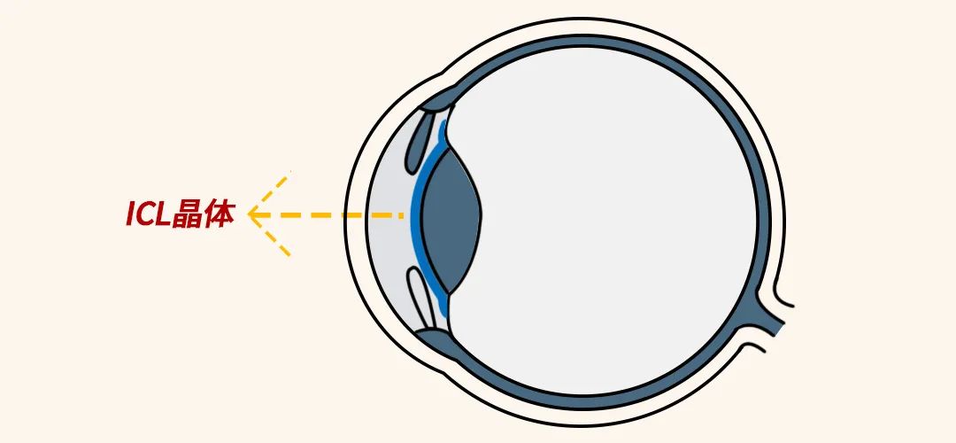 高考后迎摘镜热！在聊城这家眼科医院做ICL晶体植入术可享大福利