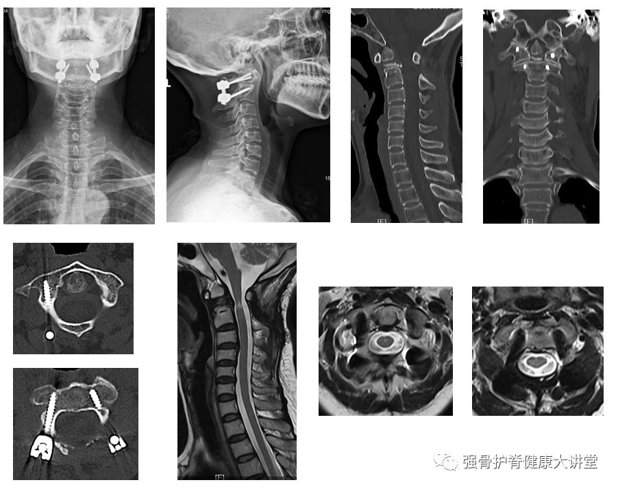 寰枢椎脱位能正骨复位吗,齿状突骨折伴寰枢关节脱位