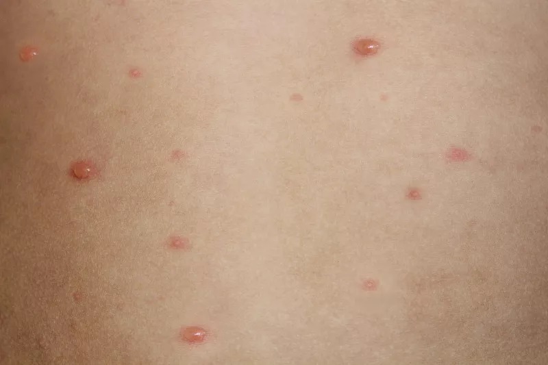 警惕艾滋病皮肤病,艾滋病会出现的初期皮肤病