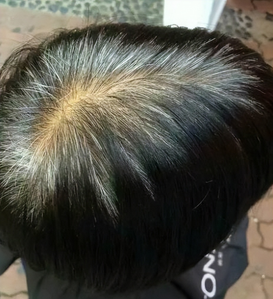 白头发变黑发需要怎么补充营养素,白头发要补什么营养素最好