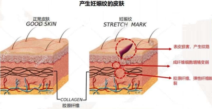 产前产后可穿短袖,产后肚皮一层皮怎么穿露脐装