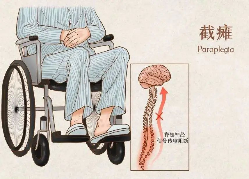 脊髓损伤截瘫一侧抖动是怎么回事,双下肢截瘫脊髓损伤恢复走路步骤